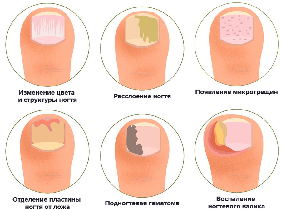 Виды онихомикоза